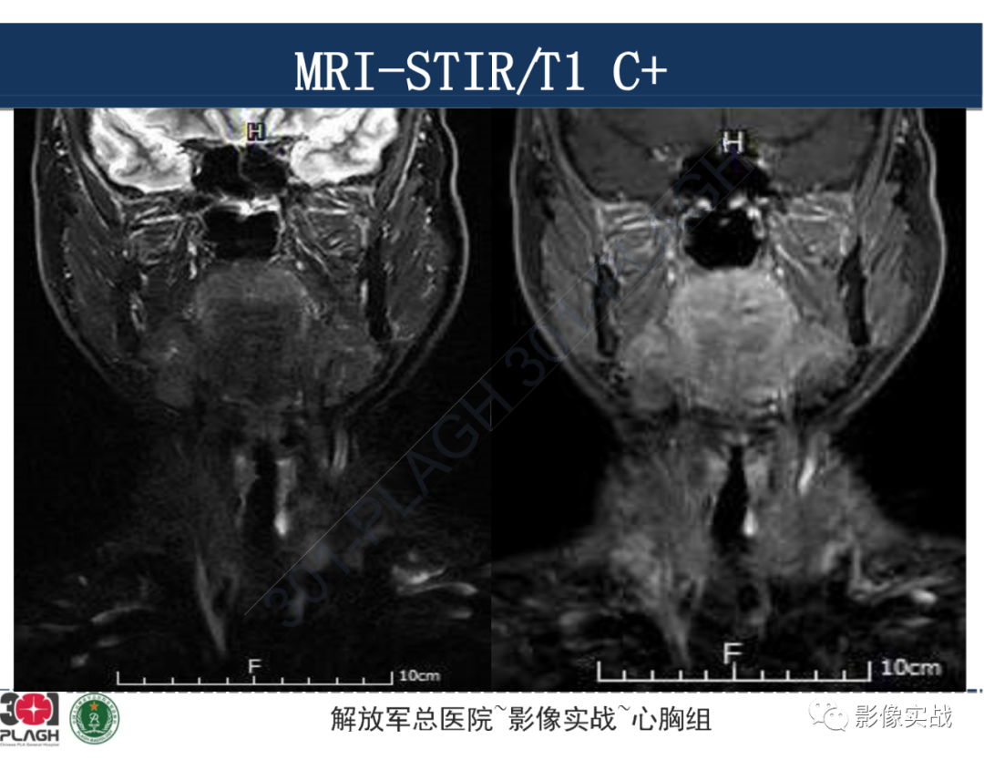 影像PPT - 【病例】气管腺样囊性癌1例CT及MR-30