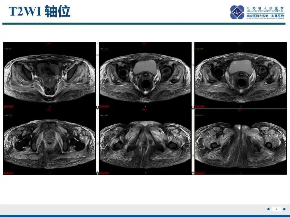 影像PPT - 【PPT】皮肌炎-6