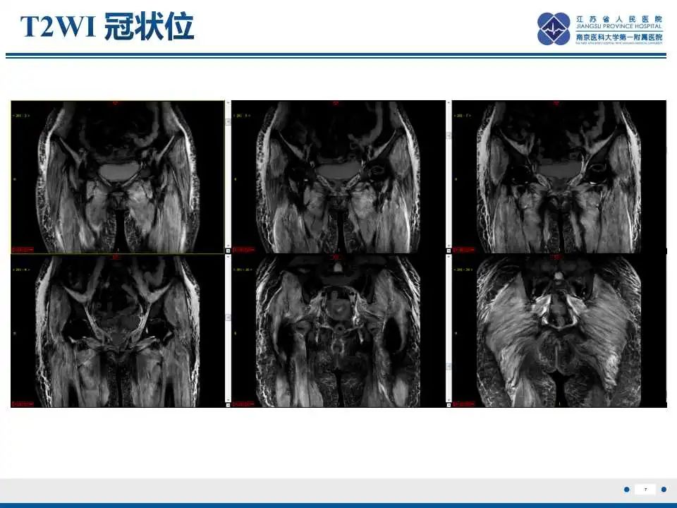 影像PPT - 【PPT】皮肌炎-8