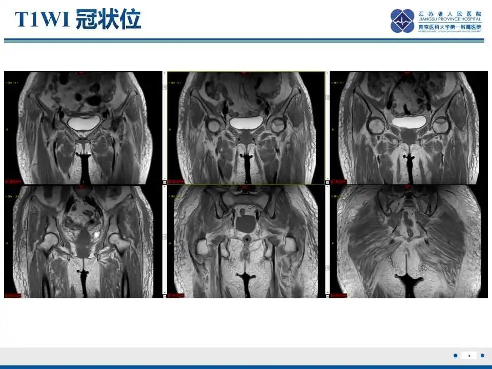 影像PPT - 【PPT】皮肌炎-7