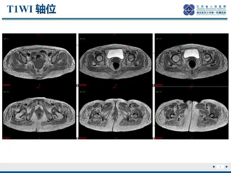 影像PPT - 【PPT】皮肌炎-5