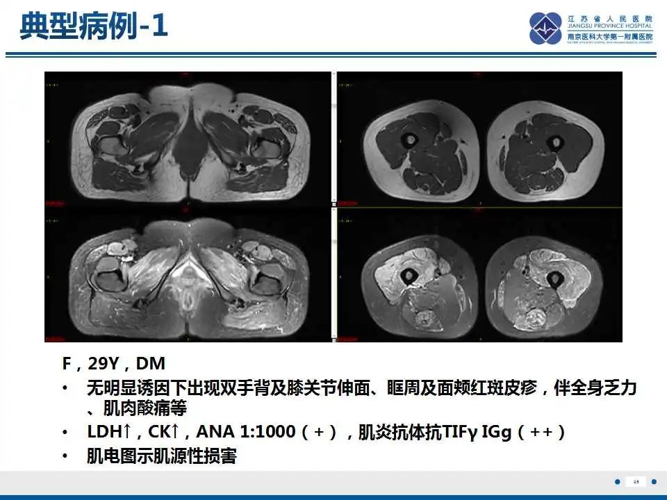 影像PPT - 【PPT】皮肌炎-26