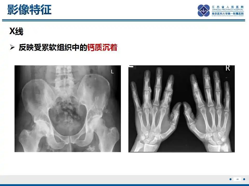 影像PPT - 【PPT】皮肌炎-27
