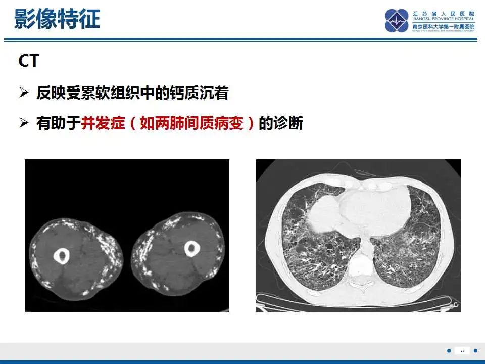 影像PPT - 【PPT】皮肌炎-28