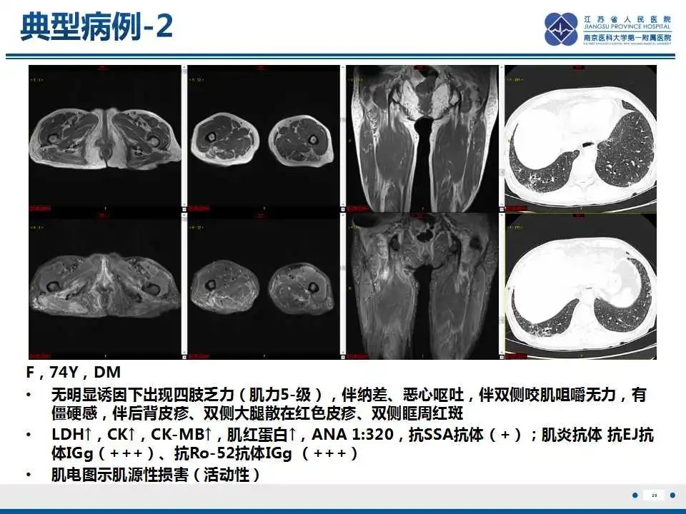 影像PPT - 【PPT】皮肌炎-29