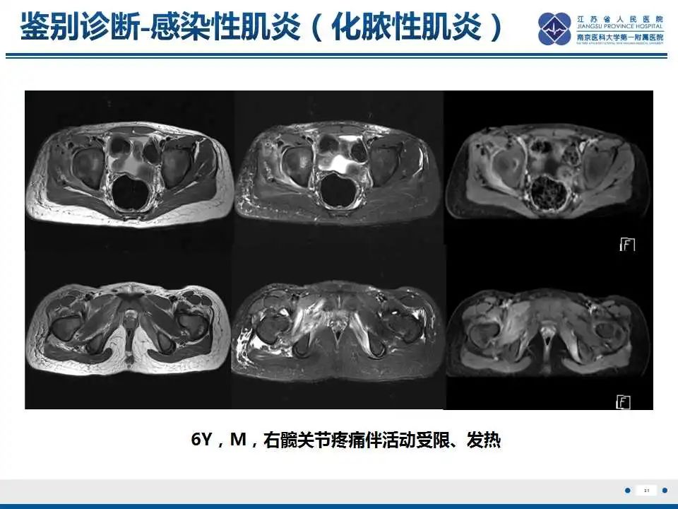 影像PPT - 【PPT】皮肌炎-32