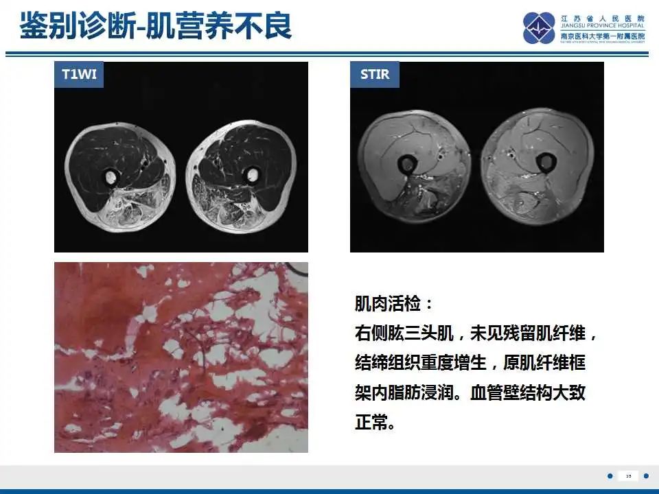 影像PPT - 【PPT】皮肌炎-36