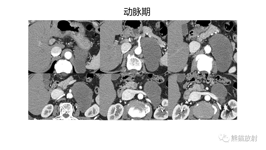 影像PPT - 【病例】节细胞神经瘤 VS 副神经节瘤-5