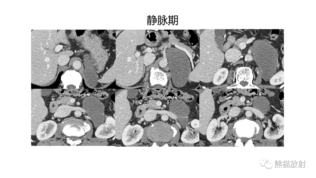 影像PPT - 【病例】节细胞神经瘤 VS 副神经节瘤-6