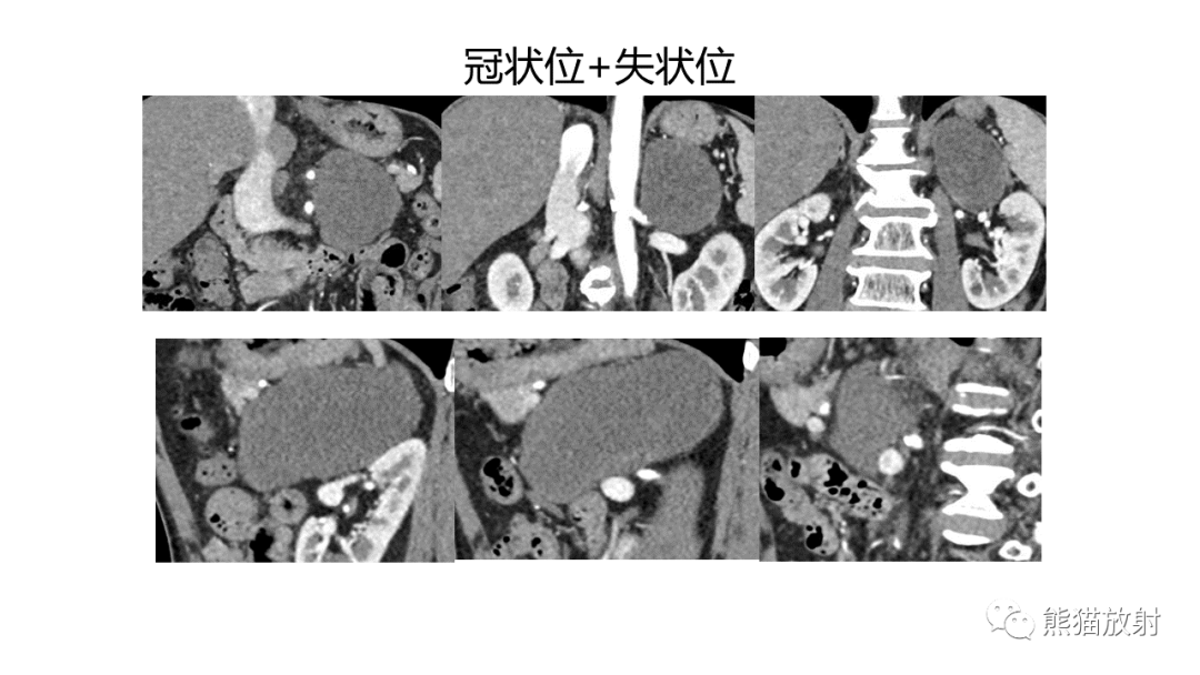 影像PPT - 【病例】节细胞神经瘤 VS 副神经节瘤-8