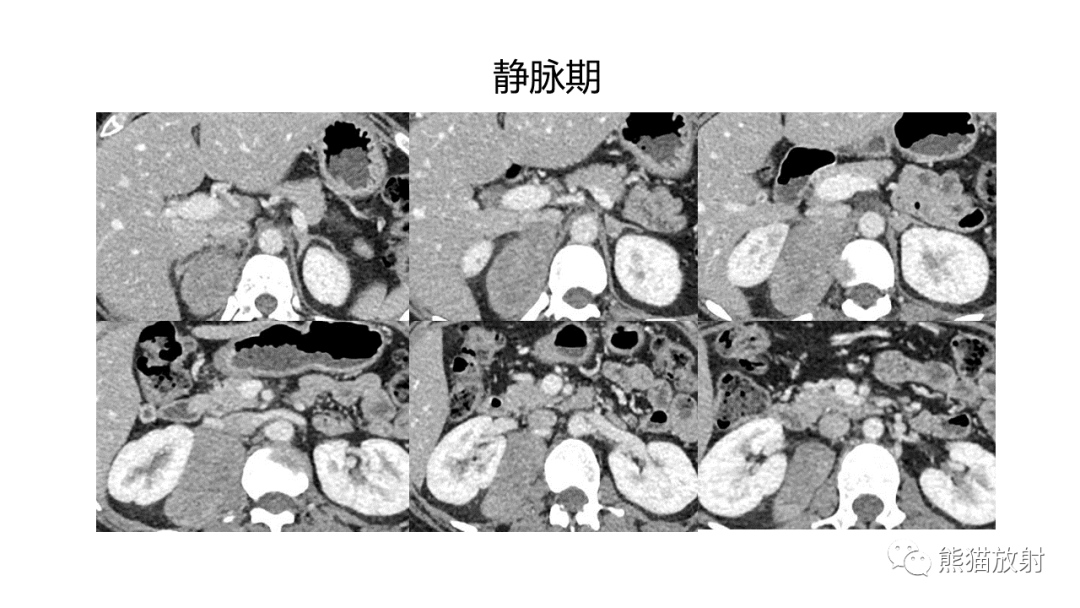影像PPT - 【病例】节细胞神经瘤 VS 副神经节瘤-15