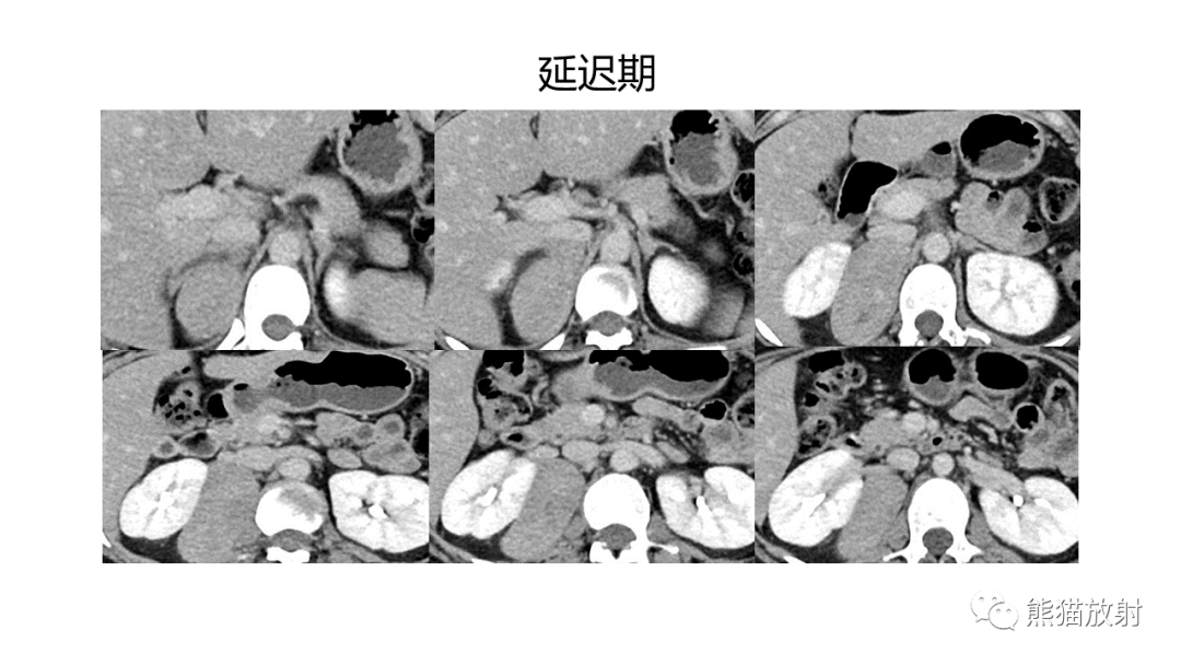 影像PPT - 【病例】节细胞神经瘤 VS 副神经节瘤-16