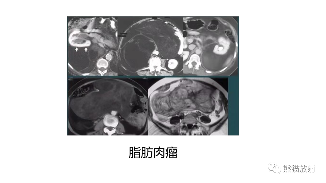 影像PPT - 【病例】节细胞神经瘤 VS 副神经节瘤-33