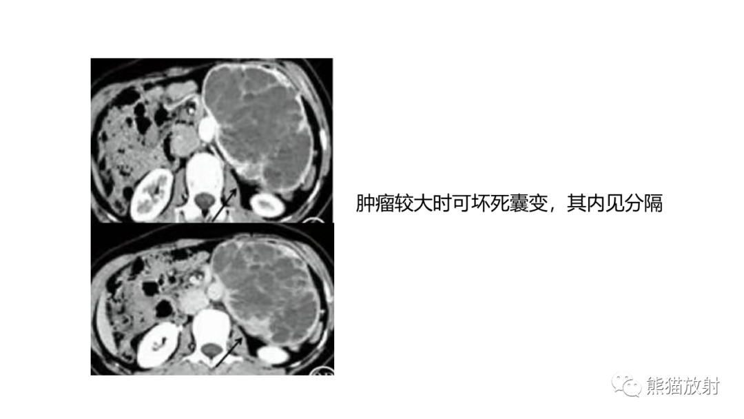 影像PPT - 【病例】节细胞神经瘤 VS 副神经节瘤-29