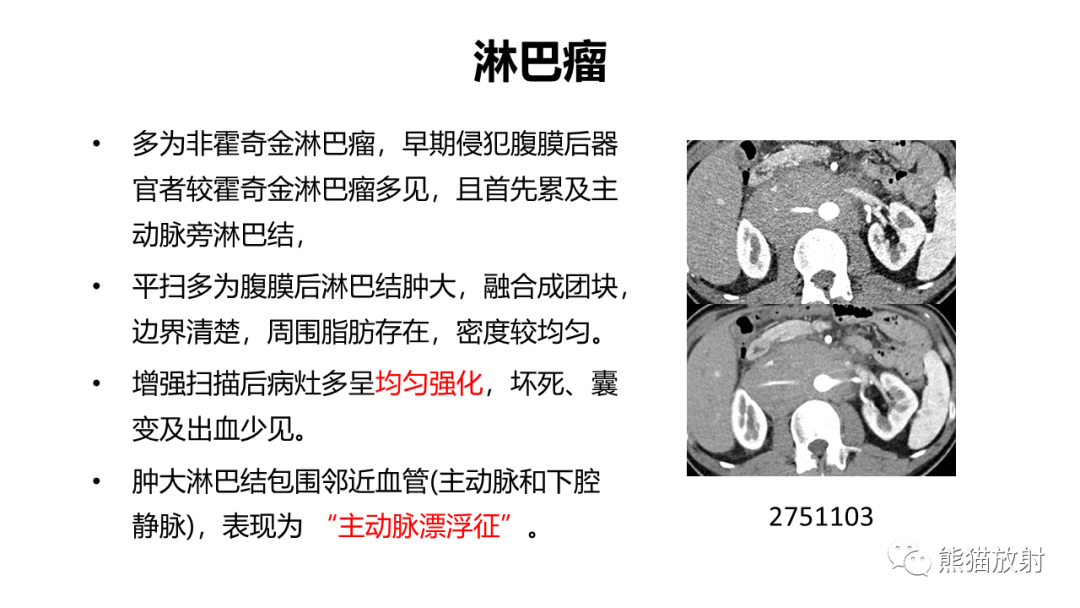 影像PPT - 【病例】节细胞神经瘤 VS 副神经节瘤-36