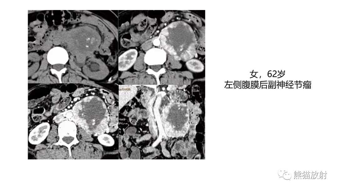 影像PPT - 【病例】节细胞神经瘤 VS 副神经节瘤-30