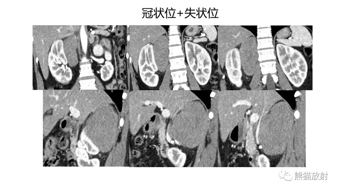 影像PPT - 【病例】节细胞神经瘤 VS 副神经节瘤-17