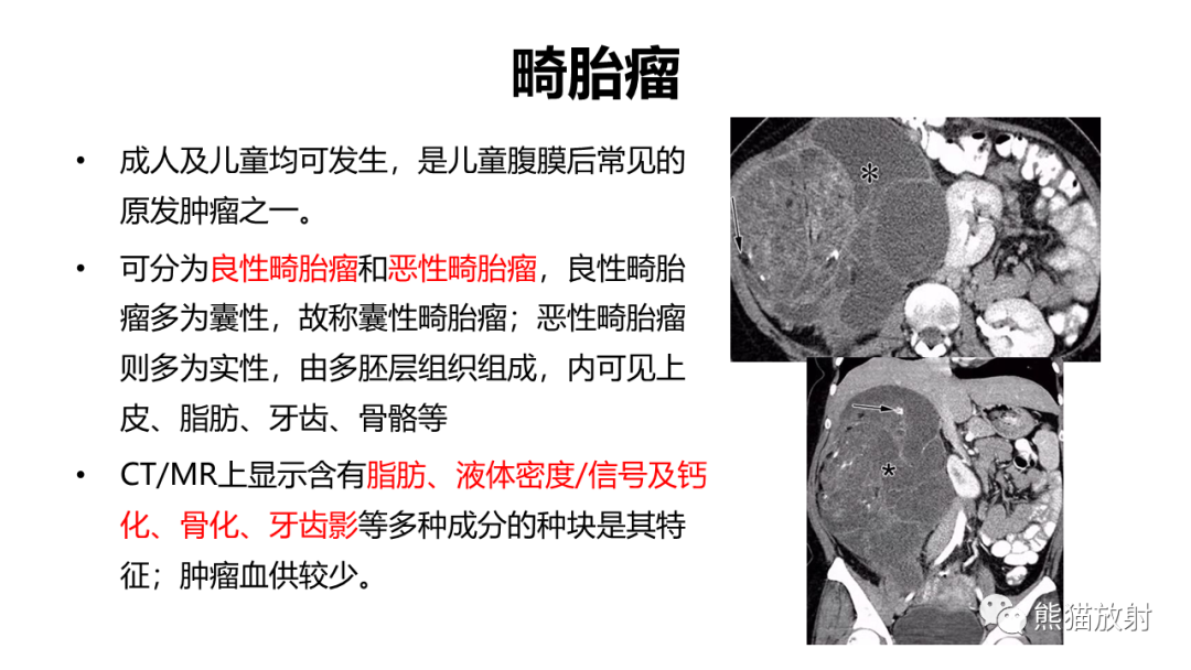 影像PPT - 【病例】节细胞神经瘤 VS 副神经节瘤-37