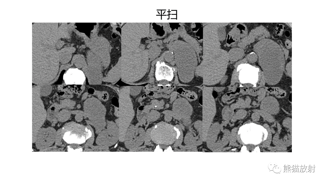 影像PPT - 【病例】节细胞神经瘤 VS 副神经节瘤-4