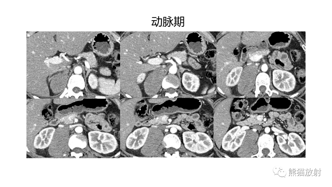 影像PPT - 【病例】节细胞神经瘤 VS 副神经节瘤-1