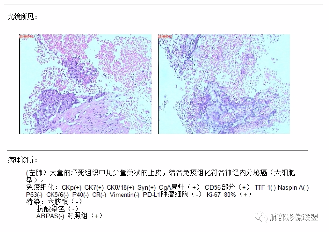 影像PPT - 【病例】肺门区跨叶占位病变1例CT诊断要点-27 影像PPT - 【病例】肺门区跨叶占位病变1例CT诊断要点-27