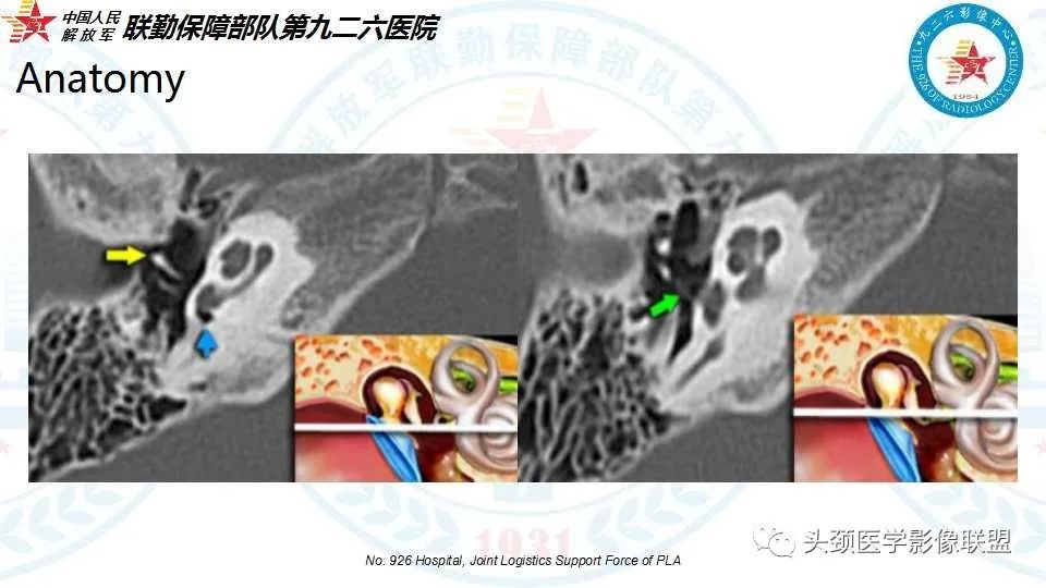 影像PPT - 【PPT】耳硬化症的临床、病理及HRCT表现-6 影像PPT - 【PPT】耳硬化症的临床、病理及HRCT表现-6