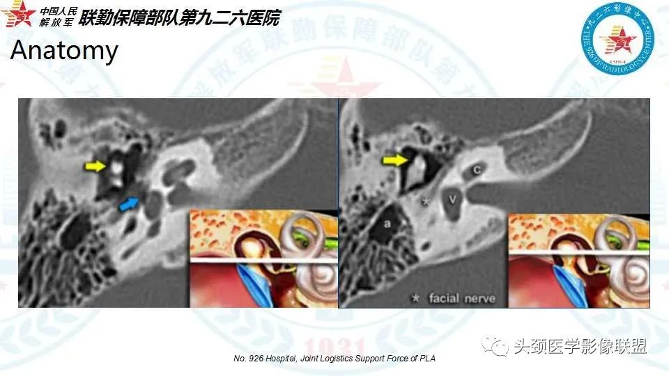影像PPT - 【PPT】耳硬化症的临床、病理及HRCT表现-7 影像PPT - 【PPT】耳硬化症的临床、病理及HRCT表现-7