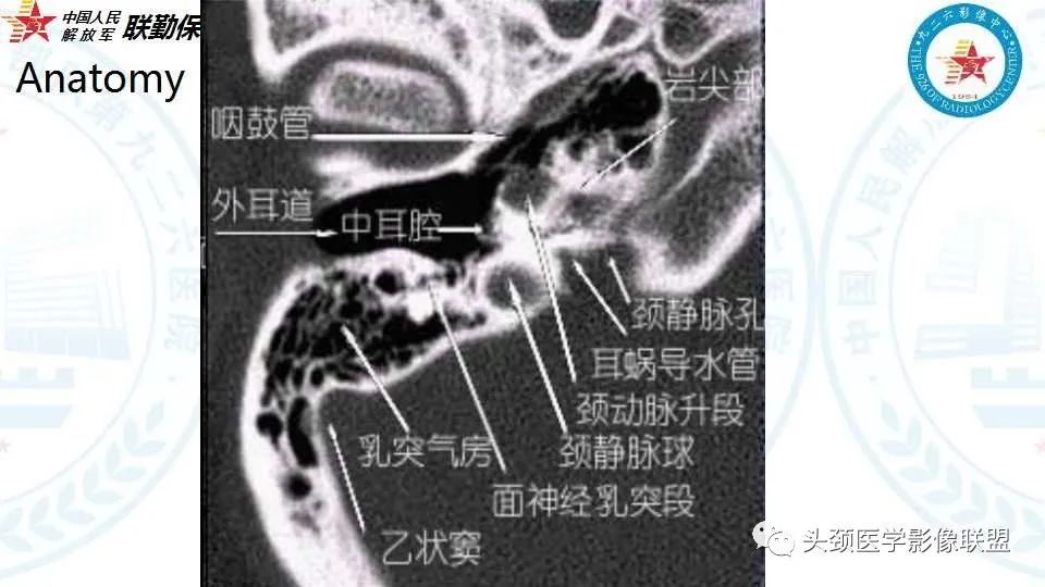 影像PPT - 【PPT】耳硬化症的临床、病理及HRCT表现-4 影像PPT - 【PPT】耳硬化症的临床、病理及HRCT表现-4
