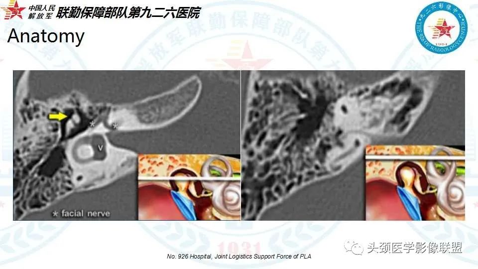影像PPT - 【PPT】耳硬化症的临床、病理及HRCT表现-8 影像PPT - 【PPT】耳硬化症的临床、病理及HRCT表现-8