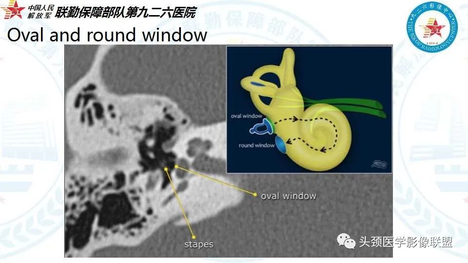 影像PPT - 【PPT】耳硬化症的临床、病理及HRCT表现-9 影像PPT - 【PPT】耳硬化症的临床、病理及HRCT表现-9