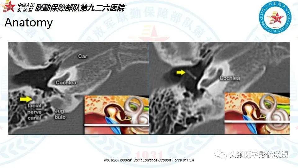 影像PPT - 【PPT】耳硬化症的临床、病理及HRCT表现-5 影像PPT - 【PPT】耳硬化症的临床、病理及HRCT表现-5