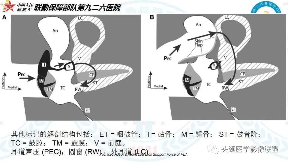影像PPT - 【PPT】耳硬化症的临床、病理及HRCT表现-11 影像PPT - 【PPT】耳硬化症的临床、病理及HRCT表现-11