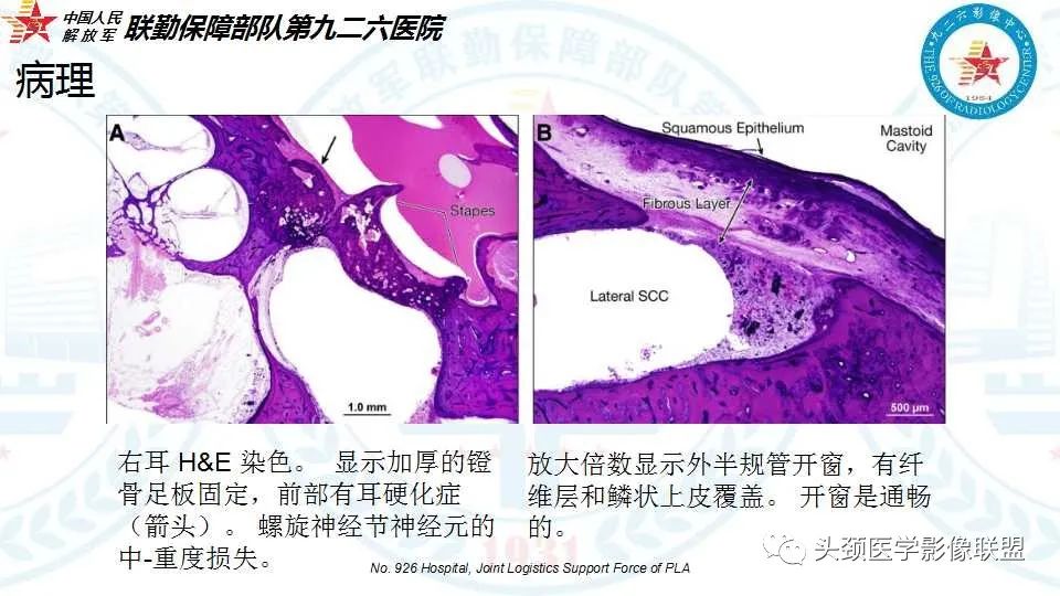 影像PPT - 【PPT】耳硬化症的临床、病理及HRCT表现-13 影像PPT - 【PPT】耳硬化症的临床、病理及HRCT表现-13