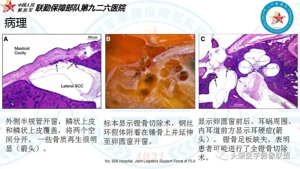 影像PPT - 【PPT】耳硬化症的临床、病理及HRCT表现-14 影像PPT - 【PPT】耳硬化症的临床、病理及HRCT表现-14