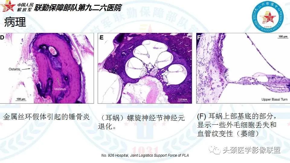 影像PPT - 【PPT】耳硬化症的临床、病理及HRCT表现-15 影像PPT - 【PPT】耳硬化症的临床、病理及HRCT表现-15