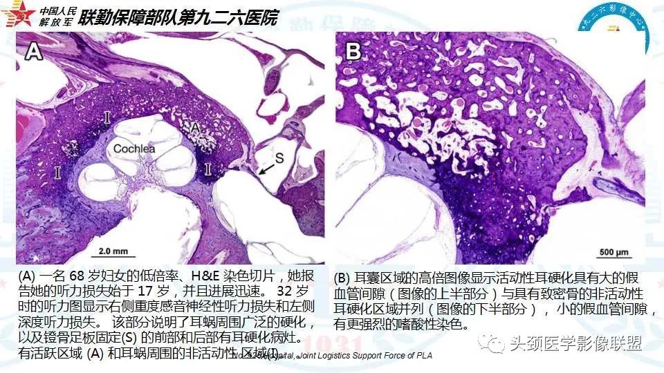 影像PPT - 【PPT】耳硬化症的临床、病理及HRCT表现-16 影像PPT - 【PPT】耳硬化症的临床、病理及HRCT表现-16