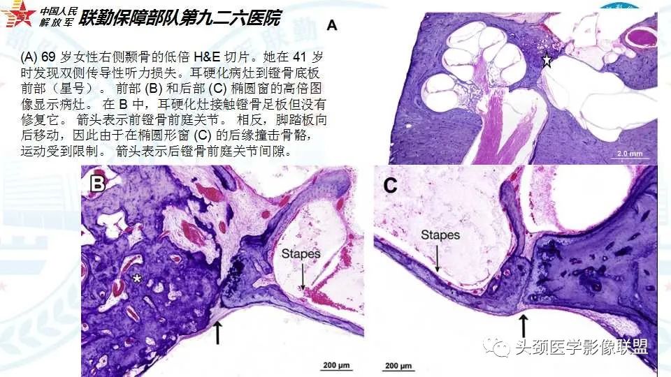 影像PPT - 【PPT】耳硬化症的临床、病理及HRCT表现-17 影像PPT - 【PPT】耳硬化症的临床、病理及HRCT表现-17