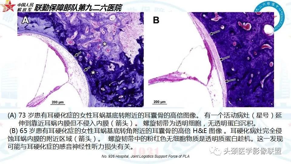 影像PPT - 【PPT】耳硬化症的临床、病理及HRCT表现-18 影像PPT - 【PPT】耳硬化症的临床、病理及HRCT表现-18