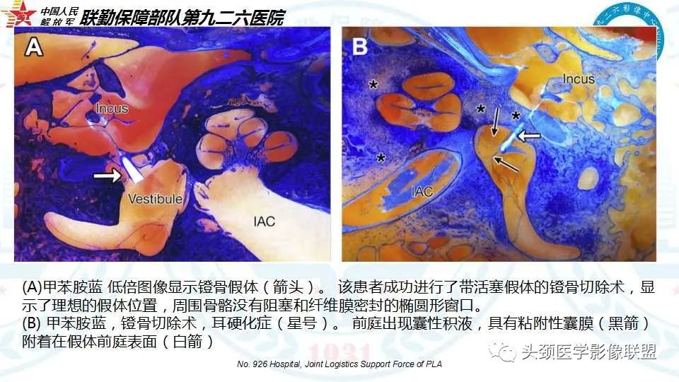 影像PPT - 【PPT】耳硬化症的临床、病理及HRCT表现-19 影像PPT - 【PPT】耳硬化症的临床、病理及HRCT表现-19