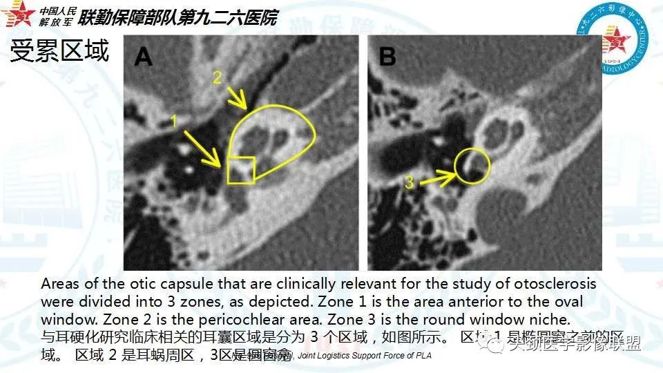 影像PPT - 【PPT】耳硬化症的临床、病理及HRCT表现-20 影像PPT - 【PPT】耳硬化症的临床、病理及HRCT表现-20