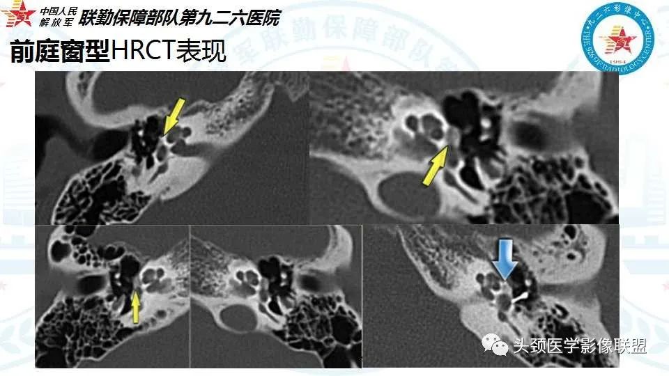 影像PPT - 【PPT】耳硬化症的临床、病理及HRCT表现-23 影像PPT - 【PPT】耳硬化症的临床、病理及HRCT表现-23