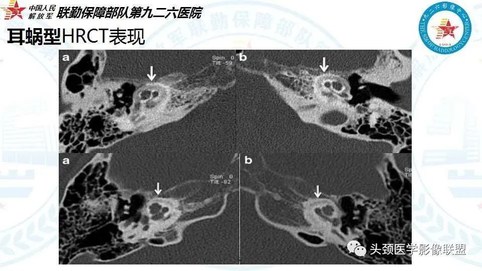 影像PPT - 【PPT】耳硬化症的临床、病理及HRCT表现-28 影像PPT - 【PPT】耳硬化症的临床、病理及HRCT表现-28