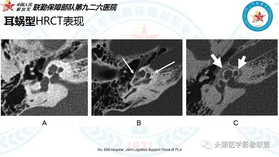 影像PPT - 【PPT】耳硬化症的临床、病理及HRCT表现-29 影像PPT - 【PPT】耳硬化症的临床、病理及HRCT表现-29