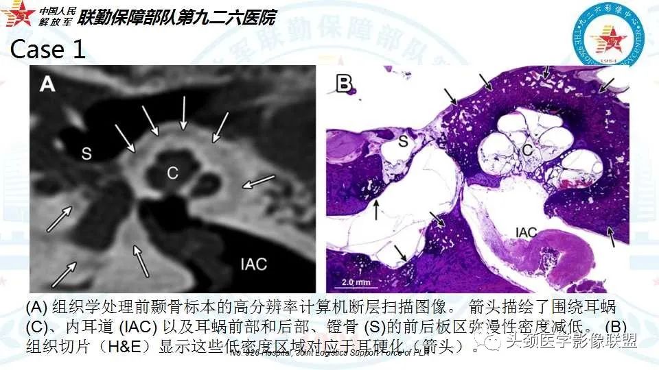 影像PPT - 【PPT】耳硬化症的临床、病理及HRCT表现-31 影像PPT - 【PPT】耳硬化症的临床、病理及HRCT表现-31