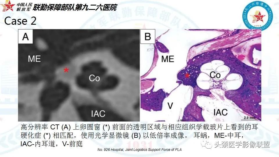 影像PPT - 【PPT】耳硬化症的临床、病理及HRCT表现-32 影像PPT - 【PPT】耳硬化症的临床、病理及HRCT表现-32