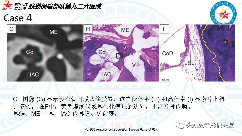 影像PPT - 【PPT】耳硬化症的临床、病理及HRCT表现-33 影像PPT - 【PPT】耳硬化症的临床、病理及HRCT表现-33