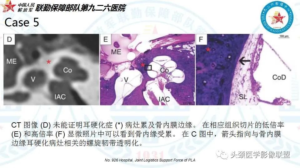 影像PPT - 【PPT】耳硬化症的临床、病理及HRCT表现-34 影像PPT - 【PPT】耳硬化症的临床、病理及HRCT表现-34