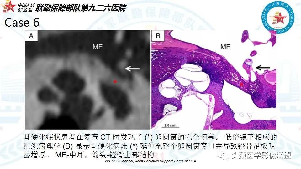 影像PPT - 【PPT】耳硬化症的临床、病理及HRCT表现-35 影像PPT - 【PPT】耳硬化症的临床、病理及HRCT表现-35