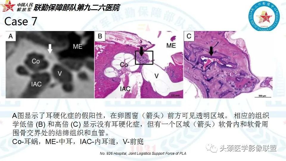 影像PPT - 【PPT】耳硬化症的临床、病理及HRCT表现-36 影像PPT - 【PPT】耳硬化症的临床、病理及HRCT表现-36
