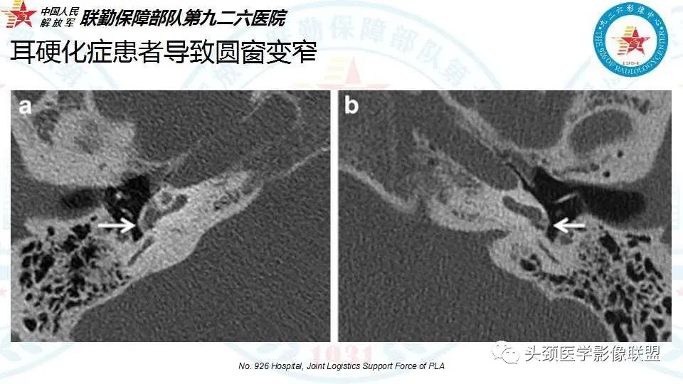 影像PPT - 【PPT】耳硬化症的临床、病理及HRCT表现-39 影像PPT - 【PPT】耳硬化症的临床、病理及HRCT表现-39